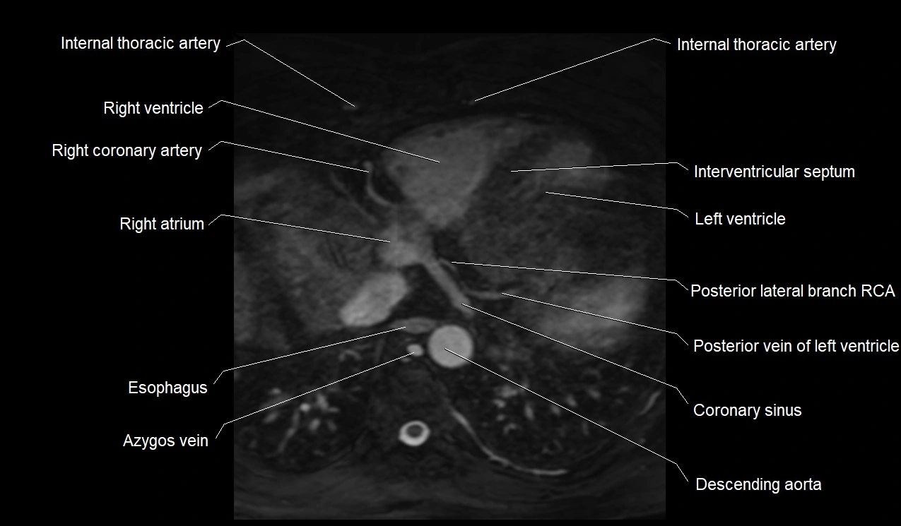 MRI heart coronary arteries and coronary veins anatomy axial image 37.webp